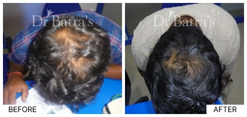 Hair Falling Treatment